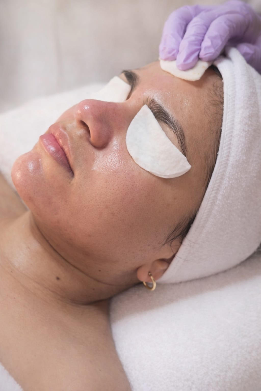 Melanze peel facial treatment in Doral Florida